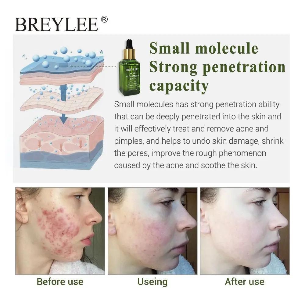 BREYLEE  Acne Repair Serum – Sérum Anti-Acné & Réparateur aux Extraits de Plantes Naturelles PINK COCO